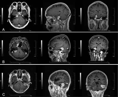 Small Cerebellopontine Angle Meningioma—Surgical Experience of 162 Patients and Literature Review